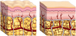 Cellulite fat cells and normal fat cells